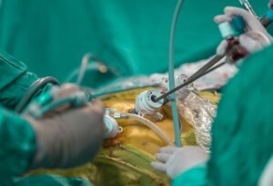 Read more about the article Open Surgery or Laparoscopic Surgery: Which Offers Faster Recovery?